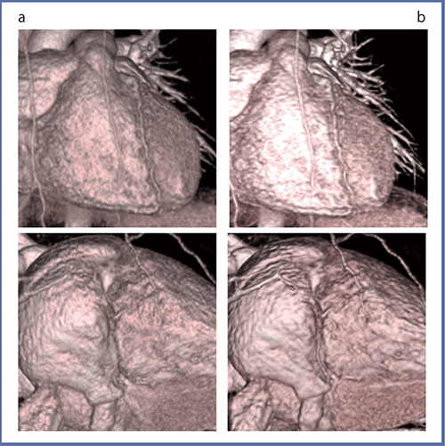 図1　FIRSTでの小児心臓CTの血管描出　a：従来法　b：FIRST