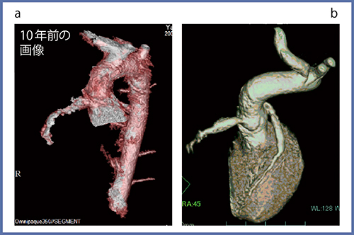 図2　FIRSTによる川崎病性冠動脈瘤の描出（1歳）　a：64列CT＋従来法　b：ADCT＋FIRST