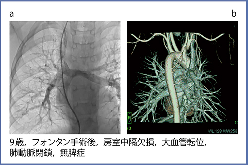 図5　フォンタン手術におけるADCTとFIRSTでの心血管構造の描出