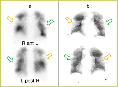 図1　肺血流シンチグラフィのplanar画像とplanar-LSVの対比1） a：99ｍTc-MAA肺血流シンチグラフィplanar画像 b：planar-LSV