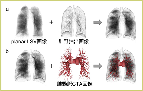 図2　planar-LSVと肺野抽出画像，CTA画像の重ね合わせ2） a：planar-LSV＋肺野抽出画像 b：aの画像＋CTA画像