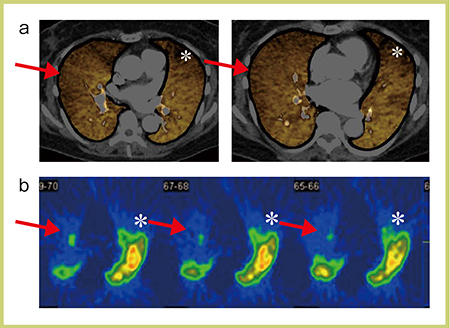 図3　Lung Iodine MAPとSPECT画像の比較 a：Lung Iodine MAP b：99ｍTc-MAA肺血流シンチグラフィ（SPECT）