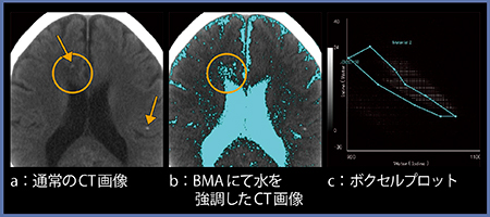 図2　BMAを用いた水強調画像の例（脳転移の症例）