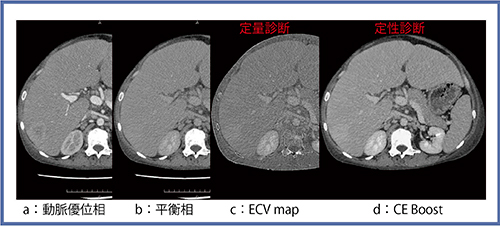図2　悪性リンパ腫肝浸潤の経過観察（40歳代，男性）