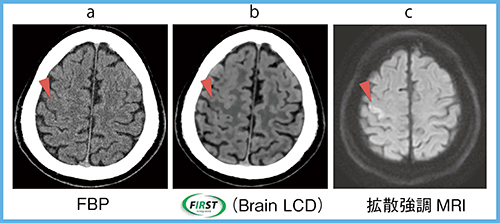 図6　頭部CT（急性期脳梗塞）