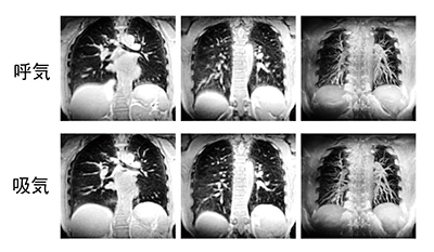 図1　呼吸による肺野の描出能の差