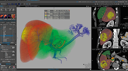 図6　CT肝臓区域セグメンテーション解析画面