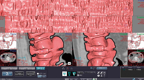 図4　大腸解析（ザイオソフト）解析画面