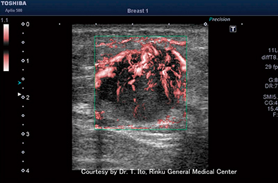 図1　乳がんのcSMI画像