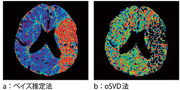 図1　左中大脳動脈閉塞による急性期脳梗塞CT perfusionのMTT map （参考文献3）より引用転載）