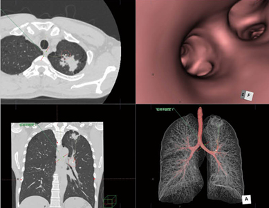 CT肺野・気管支測定による気管支VRの作成
