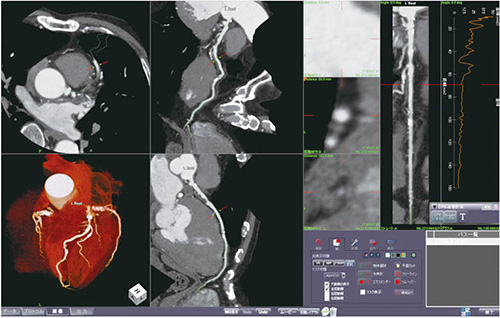 図1　冠動脈解析ソフト“CT冠動脈解析2”を起動した画面