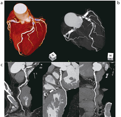 図3　冠動脈狭窄除外目的の心臓CT