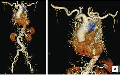 図5　胸部大動脈瘤のVolume Rendering