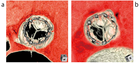 図7　Possible thrombosisに対する4Dモーション解析