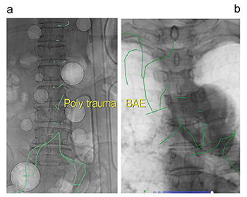 図3　多発外傷および気管支動脈塞栓術における仮想透視画像