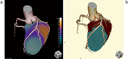 図5　CT/SPECT心臓フュージョンとCT冠動脈支配領解析の比較 a：CT/SPECT心臓フュージョン　b：支配領域解析画像