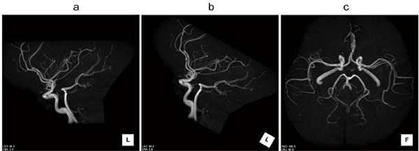 図7　脳ドックMR Angiographyの画像処理の基準画像 a：Lt -LAT　b：Lt ‒LAT 30°　c：Foot