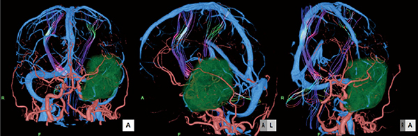 図2　動脈・静脈・腫瘍・椎体路のFusion画像
