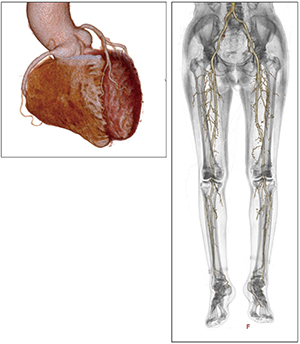 図2　冠動脈と下肢動脈造影CT（低造影剤量でIQonスペクトラルCTの仮想単色X線画像をZiostation2で画像処理）