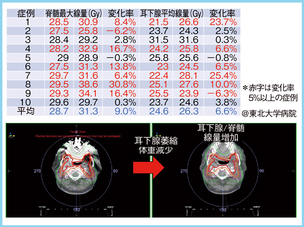 図1　耳下腺萎縮や体重減少に伴う線量変化