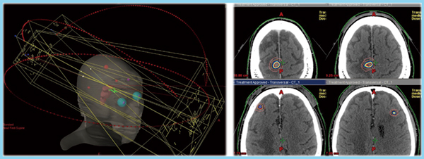 図1　多発脳転移症例のシングルアイソセンタRapidArc