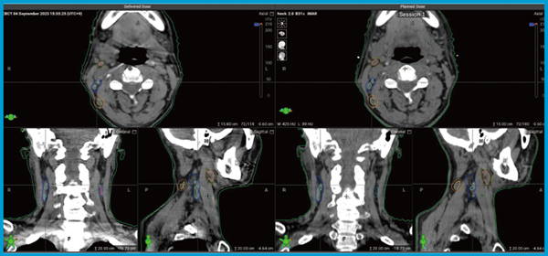 図3　HyperSightによるCBCT（中咽頭癌） 左：HyperSight　右：治療計画CT