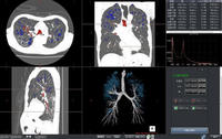 9）CT肺野・気管支測定