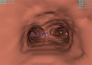 仮想気管支鏡画像の経路表示（図2）