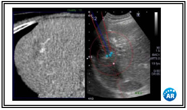 肝腫瘍の治療。右の超音波画像上に針の仮想位置が重ねて表示されている。