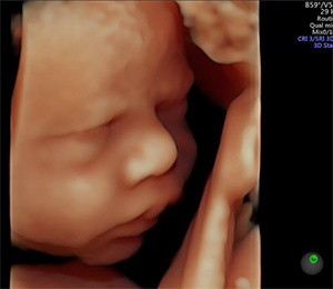Voluson S10による胎児の3次元画像