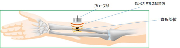 超音波骨折治療のイメージ