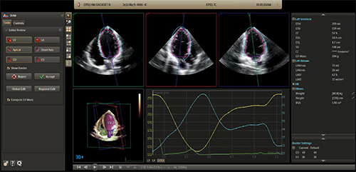 アナトミカル・インテリジェンス（AIUS）によるフルサイクルの心臓定量化（Dynamic HeartModelA.I.）