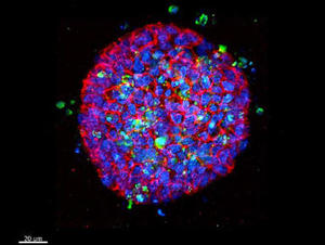 大腸がん患者から作成した細胞モデルの3次元解析結果 3次元細胞モデルに薬剤を投与。投薬後，死細胞が確認できる。（青:通常の細胞核，緑:死細胞）