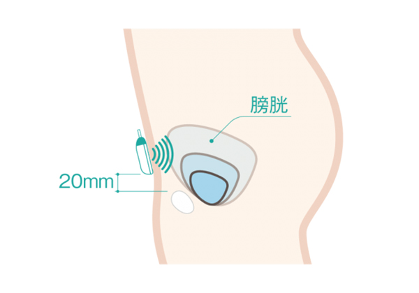 DFreeの仕組み：下腹部に装着した本体の超音波で膀胱の変化を捉える