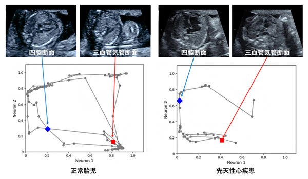 図2 胎児心臓超音波スクリーニング動画へのグラフチャート図の適用