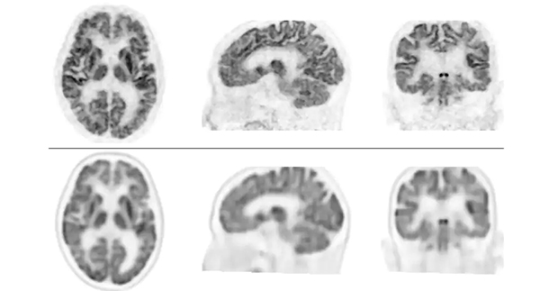 上段：本PET装置により得られた脳FDG-PET画像 下段：従来型装置により得られた脳FDG-PET画像 上段の画像の方が分解能が高く，細かいところまでみえる。下段の方は少しぼやけてみえる。
