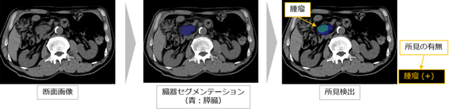 腫瘤（直接所見）を検出した症例（ステージ1）