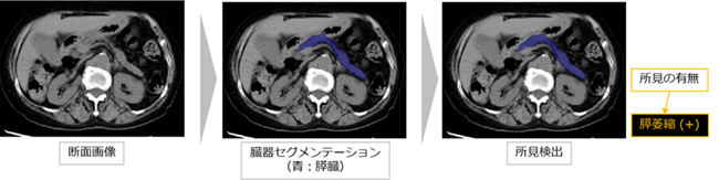腫瘤（直接所見）が描出されていないが膵萎縮（間接所見）を検出した症例（ステージ1）