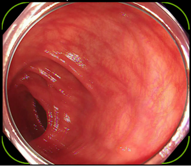 大腸ポリープがメイン画像に出現し，本品が大腸ポリープ候補と認識した時点でメイン画像四隅を囲むアラート枠が表示される。
