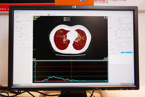 CT肺気腫計測ソフト「LungVision」