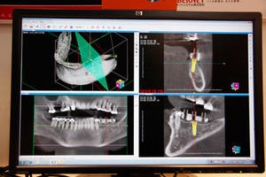 インプラント埋込シミュレーションソフトウエア「DentistVision Professional」