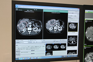肝臓腫瘤の類似画像検索が新たに可能になったSYNAPSE Case Match