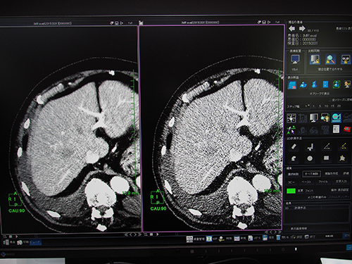 レトロスペクティブにノイズを低減する統計的CT画像ノイズ低減機能（W.I.P.）
