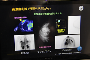 Elmammoでは高濃度乳房でも明瞭に腫瘍を確認できる。