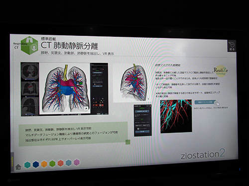 CT肺動静脈分離
