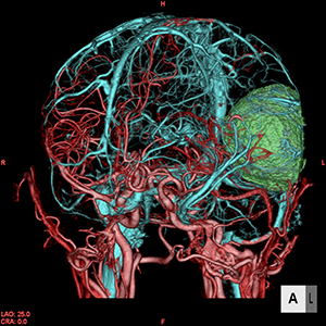 図2：動脈と静脈を分離表示