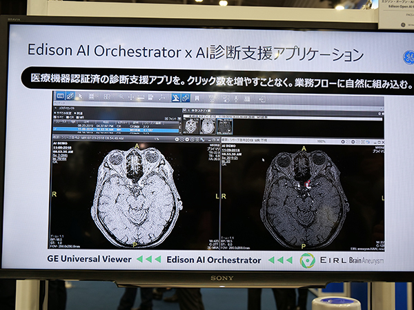 “Universal Viewer”上でのエルピクセル社の“EIRL Brain Aneurysm”の処理