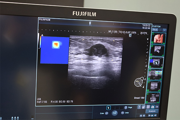 AI技術を用いた画像認識技術で乳腺スクリーニング検査における負担軽減の支援を行う「eScreening」機能