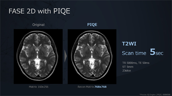 適応拡大したPIQEとFASE 2Dを組み合わせ，頭部T2WIを5秒で撮像